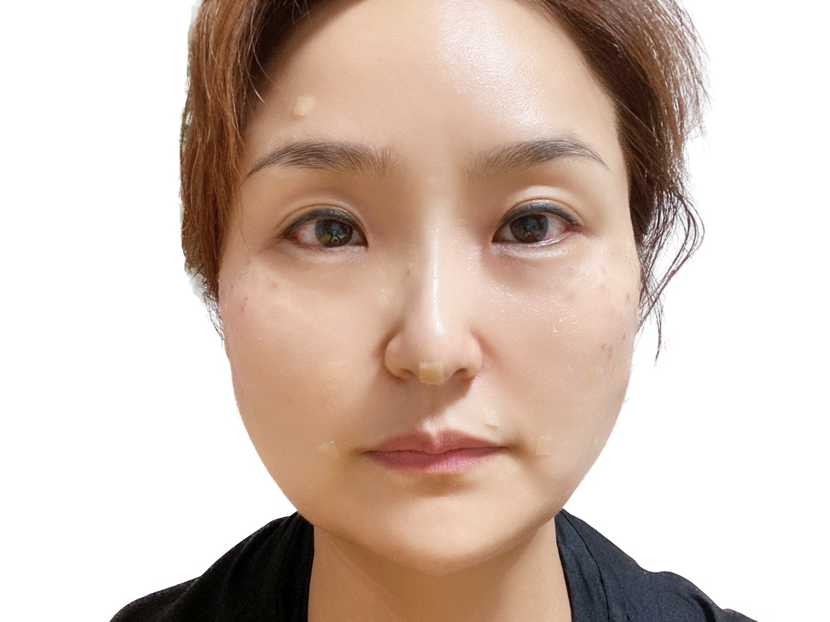 돌기실 시술 후